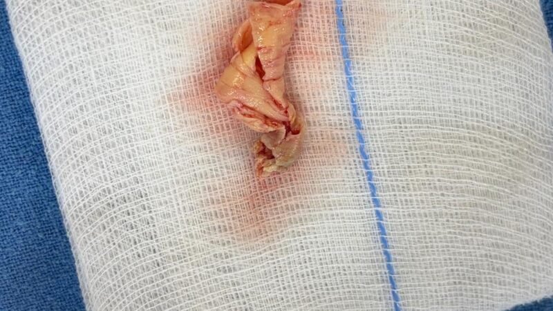 VELMED Hospital, Dehradun में स्ट्रोक से बचाव के लिए जटिल सर्जरी सफल