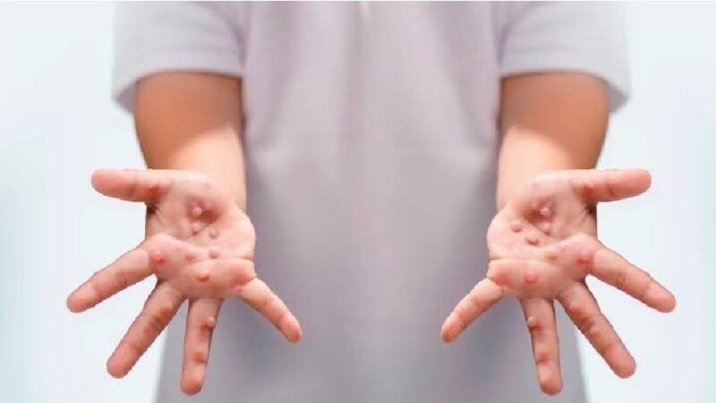 उत्तरकाशी में 15 बच्चे बीमार, आठ में कॉक्ससैकी वायरस की पुष्टि